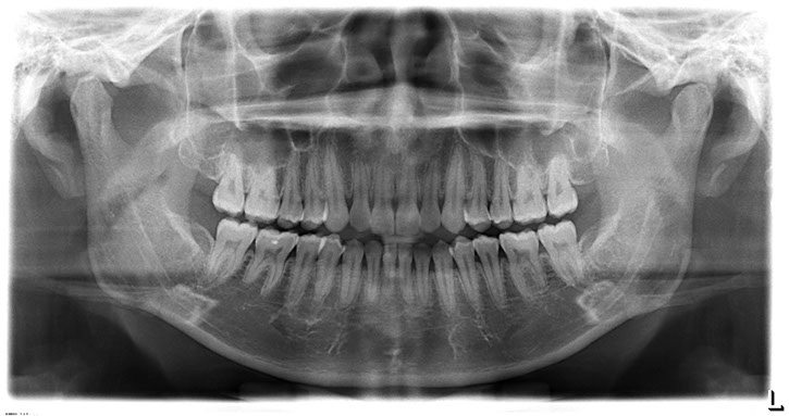 全口掃描X光攝影