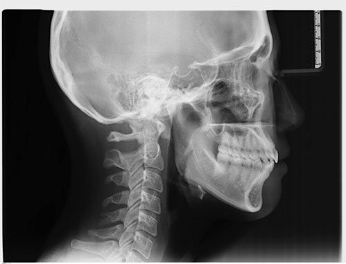 側顱X光攝影
