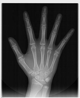 手骨X光攝影